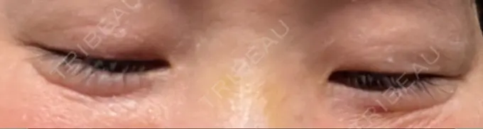 ボトックス（目尻） 湘南美容クリニック 大阪あべの院 DAY 7 メイン用