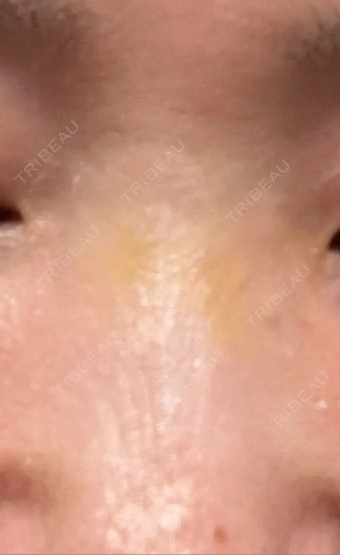 その他（鼻） 湘南美容クリニック 大阪あべの院 DAY 7 メイン用