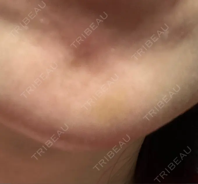 ボトックス（あご） 湘南美容クリニック 大阪あべの院 DAY 7 メイン用