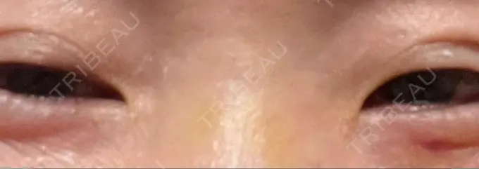 その他（目元） 湘南美容クリニック 大阪あべの院 DAY 7 メイン用