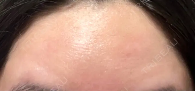 ボトックス（額） 湘南美容クリニック 大阪あべの院 DAY 7 メイン用