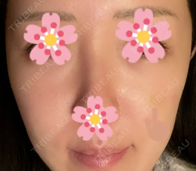 ヒアルロン酸注入（頬） 湘南美容クリニック 宇都宮院 DAY 8 メイン用