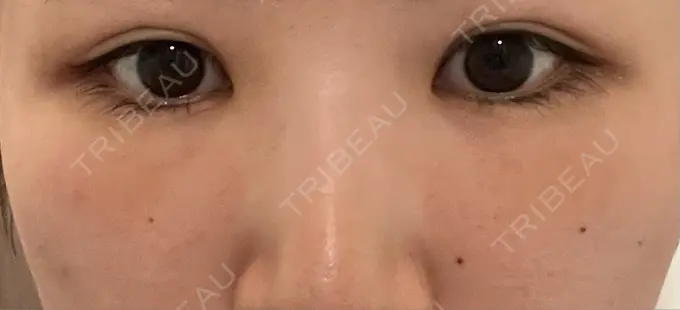 クマ治療 / 下まぶたの脂肪取り Brandnew Beauty Clinic DAY 3 メイン用