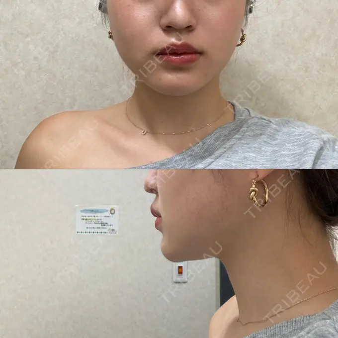 糸リフト / 脂肪吸引（顔） Casa de GRACIA GINZA 【カーサデグラシアギンザ】 DAY 37 メイン用