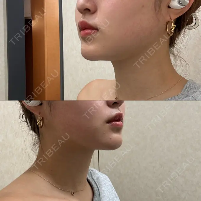 糸リフト / 脂肪吸引（顔） Casa de GRACIA GINZA 【カーサデグラシアギンザ】 DAY 37 メイン用