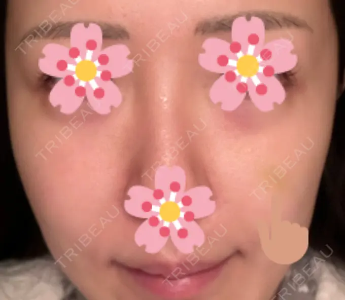 ヒアルロン酸注入（頬） 湘南美容クリニック 宇都宮院 DAY 9 メイン用