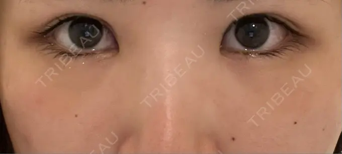 クマ治療 / 下まぶたの脂肪取り Brandnew Beauty Clinic DAY 4 メイン用