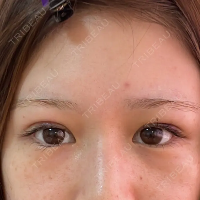 二重埋没 湘南美容クリニック 京都院 DAY 6 メイン用