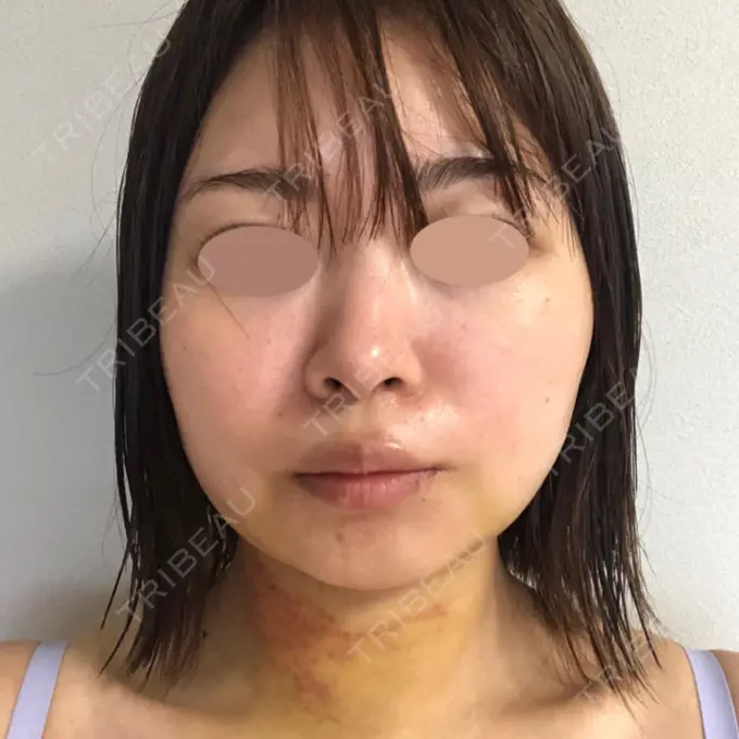 糸リフト / バッカルファット除去 / 脂肪吸引（顔） 湘南美容クリニック 京都院 DAY 4 メイン用