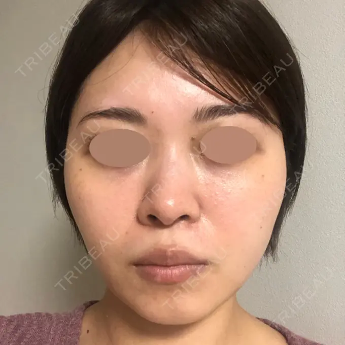 糸リフト / バッカルファット除去 / 脂肪吸引（顔） 湘南美容クリニック 京都院 DAY 4 メイン用