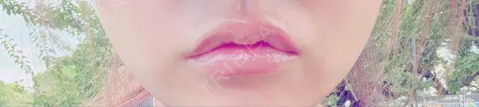 口角挙上 宇都宮竹内クリニック AFTER メイン用