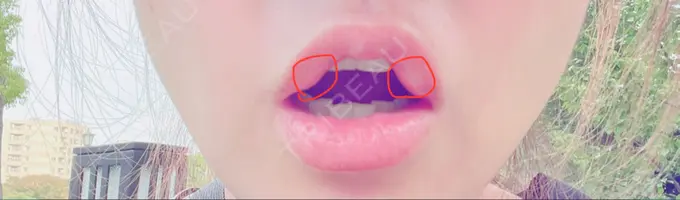 口角挙上 宇都宮竹内クリニック DAY 881 メイン用