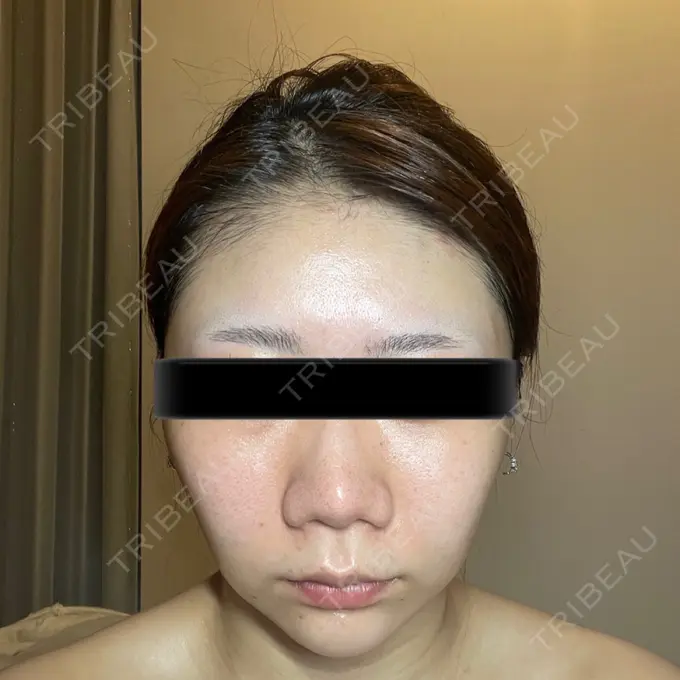 脂肪吸引（顔） / メーラーファット除去 / ボトックス（あご） / ヒアルロン酸注入（あご） / ボトックス（エラ・小顔） WOM CLINIC GINZA （ワム クリニック ギンザ） AFTER メイン用