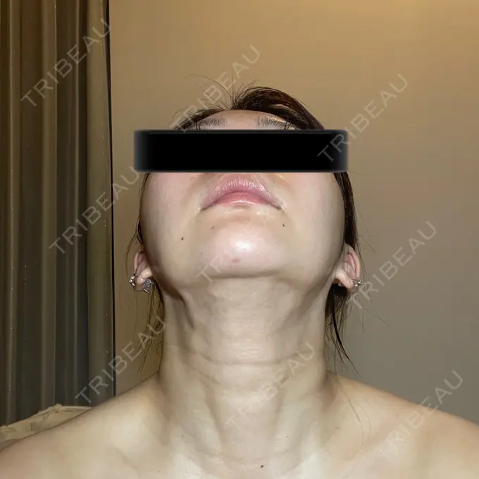 脂肪吸引（顔） / メーラーファット除去 / ボトックス（あご） / ヒアルロン酸注入（あご） / ボトックス（エラ・小顔） WOM CLINIC GINZA （ワム クリニック ギンザ） DAY 93 メイン用