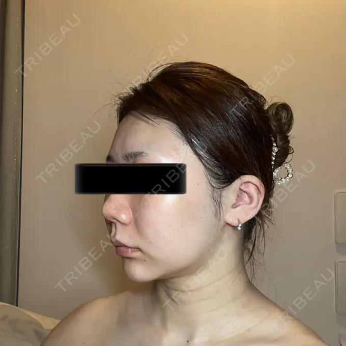 脂肪吸引（顔） / メーラーファット除去 / ボトックス（あご） / ヒアルロン酸注入（あご） / ボトックス（エラ・小顔） WOM CLINIC GINZA （ワム クリニック ギンザ） DAY 93 メイン用