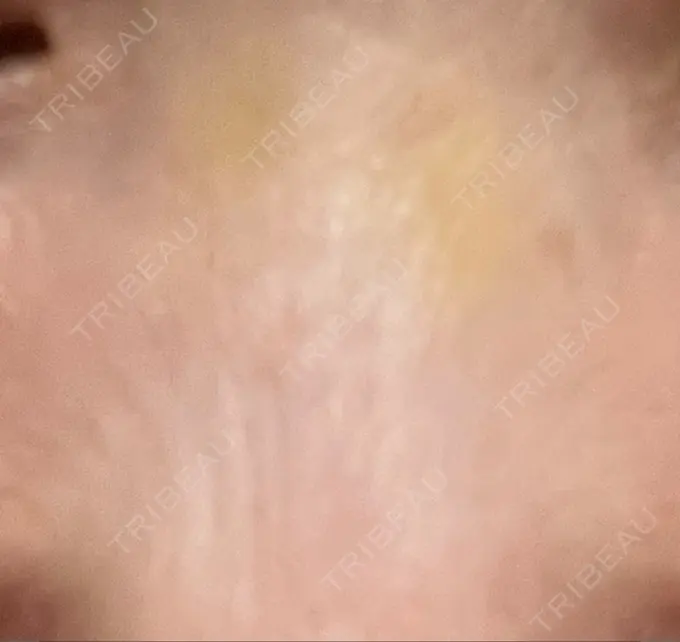 その他（鼻） 湘南美容クリニック 大阪あべの院 DAY 9 メイン用