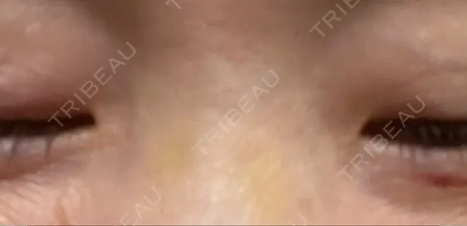 その他（目元） 湘南美容クリニック 大阪あべの院 DAY 9 メイン用