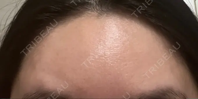 ボトックス（額） 湘南美容クリニック 大阪あべの院 DAY 9 メイン用