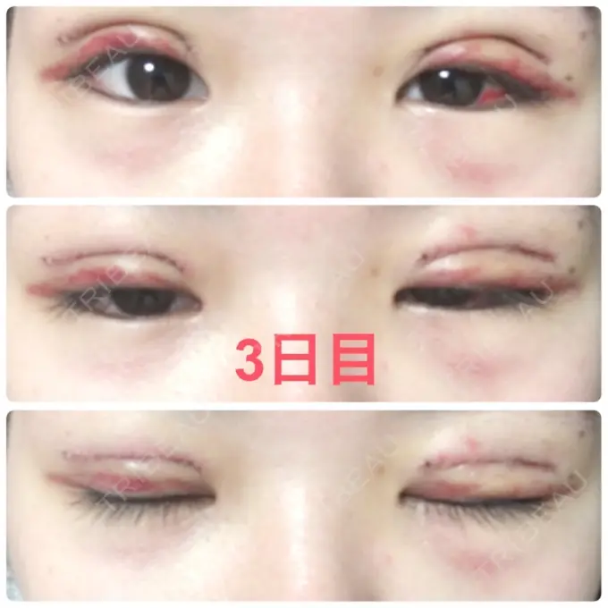 二重切開 品川スキンクリニック広島院 DAY 3 メイン用