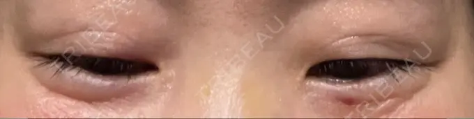 ボトックス（目尻） 湘南美容クリニック 大阪あべの院 DAY 10 メイン用