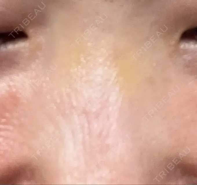 その他（鼻） 湘南美容クリニック 大阪あべの院 DAY 10 メイン用