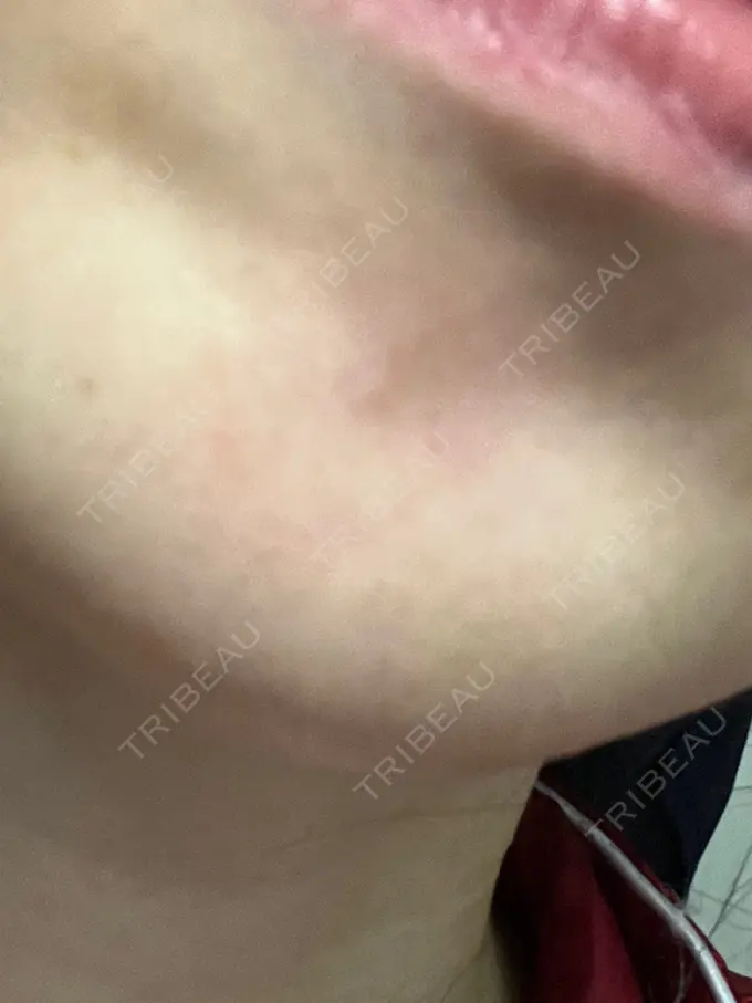 ボトックス（あご） 湘南美容クリニック 大阪あべの院 DAY 9 メイン用