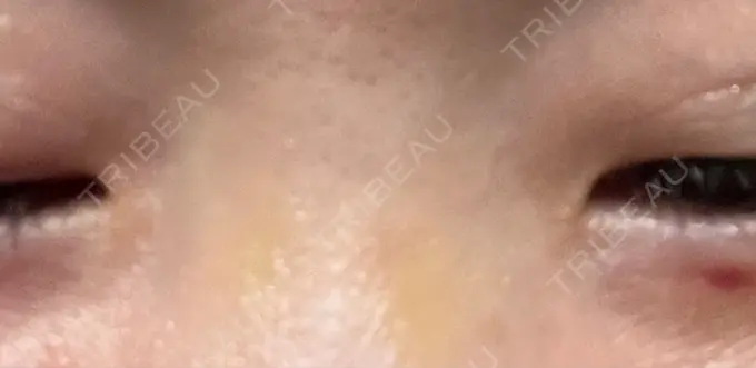 その他（目元） 湘南美容クリニック 大阪あべの院 DAY 10 メイン用