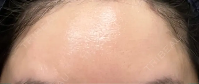 ボトックス（額） 湘南美容クリニック 大阪あべの院 DAY 10 メイン用