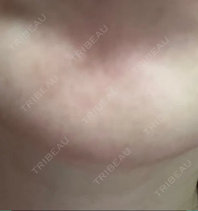 ボトックス（あご） 湘南美容クリニック 大阪あべの院 DAY 10 メイン用