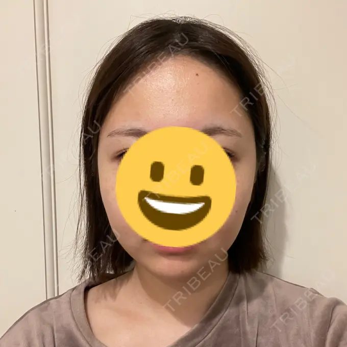 糸リフト / 脂肪吸引（顔） Casa de GRACIA GINZA 【カーサデグラシアギンザ】 DAY 9 メイン用