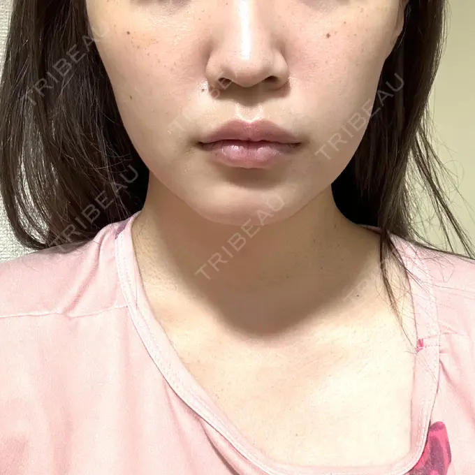 ボトックス（エラ・小顔） 東京シンデレラ美容外科 池袋院 DAY 14 メイン用