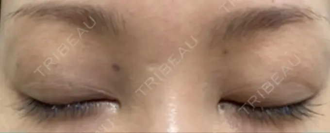 ピコレーザートーニング（美白・肝斑） / ピコスポット 日比谷セントラルクリニック AFTER メイン用