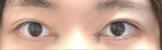 目頭切開 東京シンデレラ美容外科 池袋院 DAY 0 メイン用