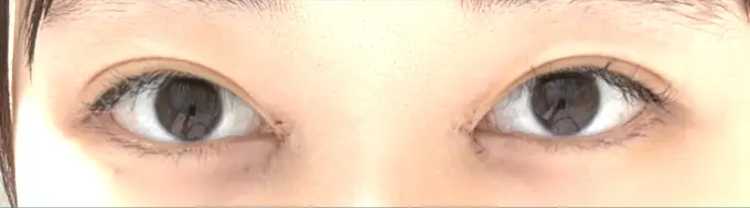 目頭切開 東京シンデレラ美容外科 池袋院 DAY 1 メイン用