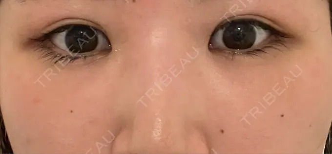 クマ治療 / 下まぶたの脂肪取り Brandnew Beauty Clinic DAY 6 メイン用