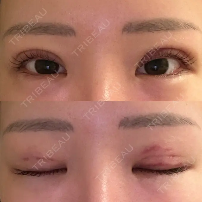 二重埋没 品川スキンクリニック 宇都宮院（※品川美容外科提携） DAY 3 メイン用