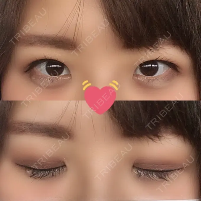 眼瞼下垂（切開） みずほクリニック DAY 73 メイン用