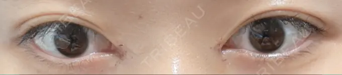 目頭切開 東京シンデレラ美容外科 池袋院 DAY 2 メイン用