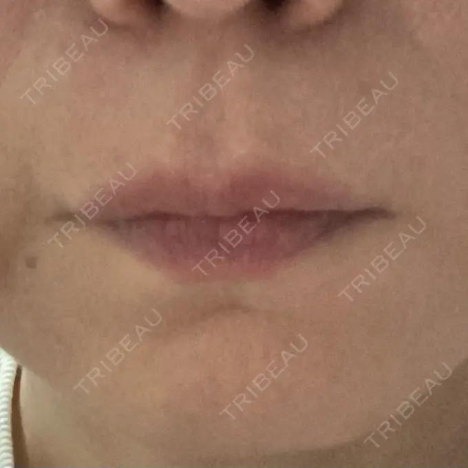 ボトックス（人中） veary clinic DAY 10 メイン用