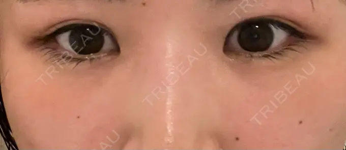 クマ治療 / 下まぶたの脂肪取り Brandnew Beauty Clinic AFTER メイン用