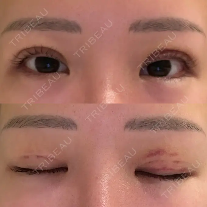 二重埋没 品川スキンクリニック 宇都宮院（※品川美容外科提携） DAY 4 メイン用