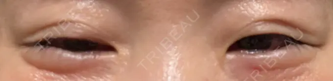 ボトックス（目尻） 湘南美容クリニック 大阪あべの院 AFTER メイン用