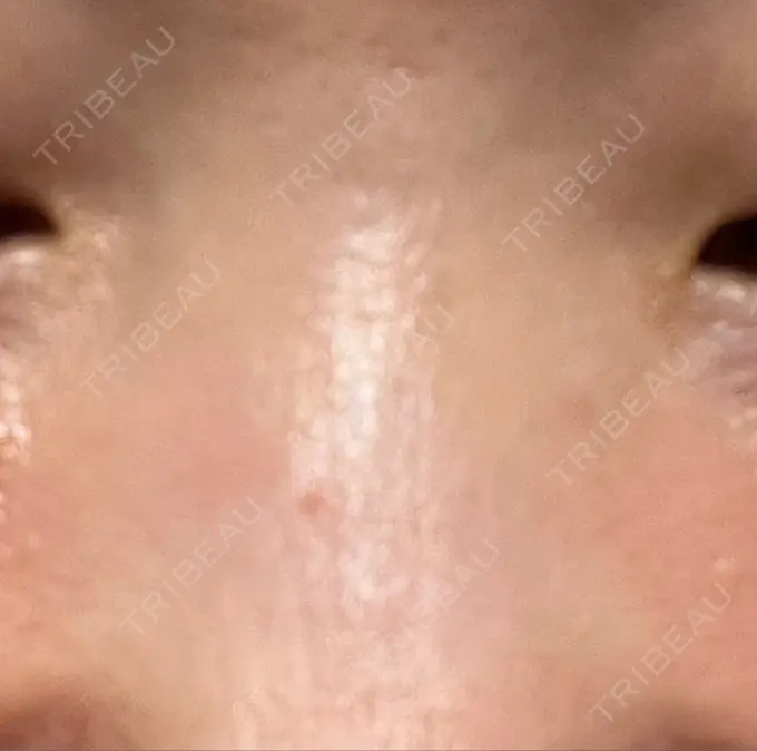 その他（鼻） 湘南美容クリニック 大阪あべの院 AFTER メイン用