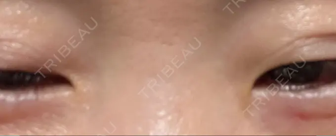 その他（目元） 湘南美容クリニック 大阪あべの院 DAY 14 メイン用