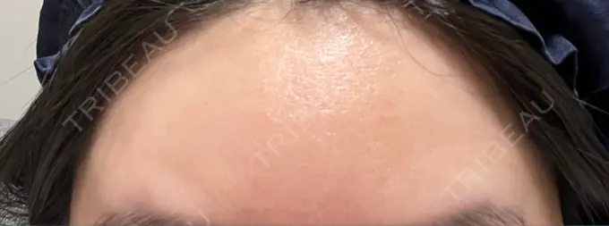 ボトックス（額） 湘南美容クリニック 大阪あべの院 AFTER メイン用