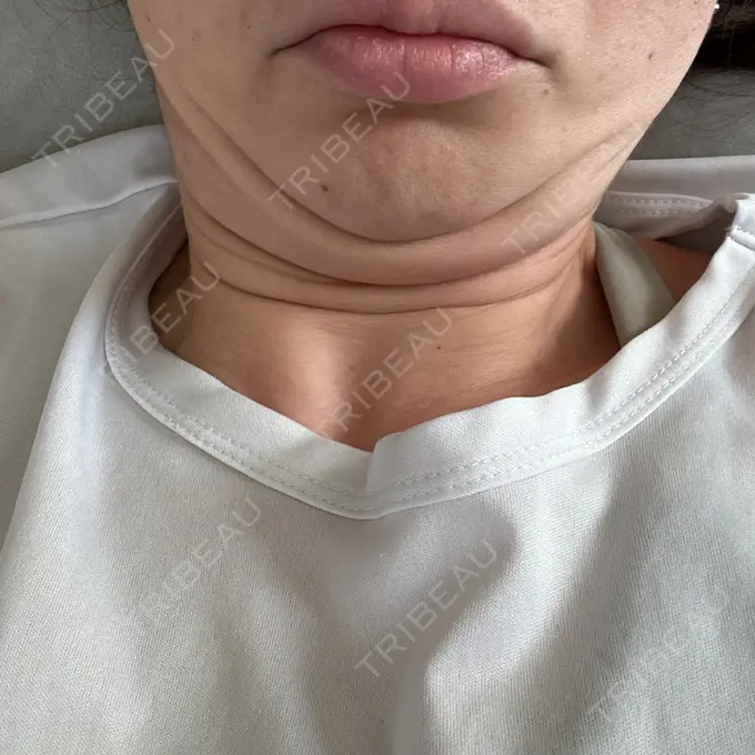 脂肪吸引注射（顔） 東京たかはしクリニック 練馬院 DAY 0 メイン用