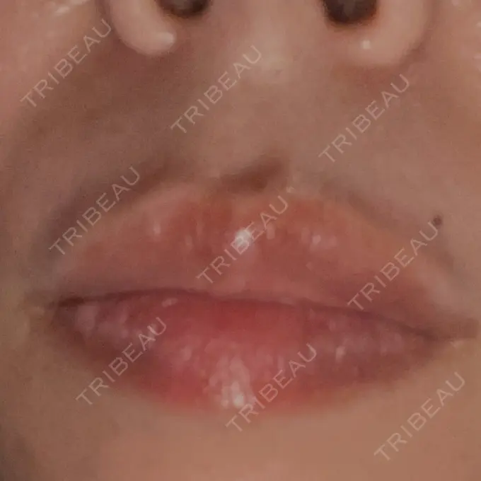 ボトックス（人中） veary clinic DAY 0 メイン用