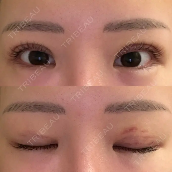 二重埋没 品川スキンクリニック 宇都宮院（※品川美容外科提携） DAY 6 メイン用