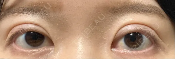 二重切開 / 目元修正 心斎橋コムロ美容外科クリニック AFTER メイン用