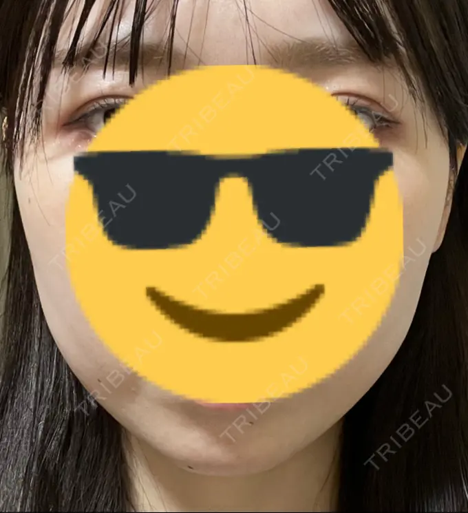 ハイフ（顔） A CLINIC（エークリニック） 横浜院 AFTER メイン用